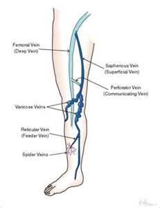 What-Causes-Varicose-Veins?